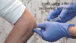 BPG Injection sites and methods [upl. by Sally]