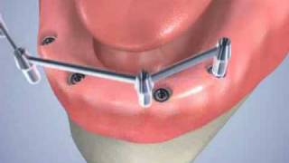 pose de 4 implants dentaires avec une barre dattachement [upl. by Nuhsyar]